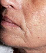 Vor eine Micro Needling Kur